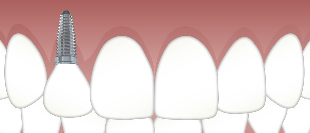dent-sur-pivot-inlay-core-guide-conseils-soin-dentaire-dentegp